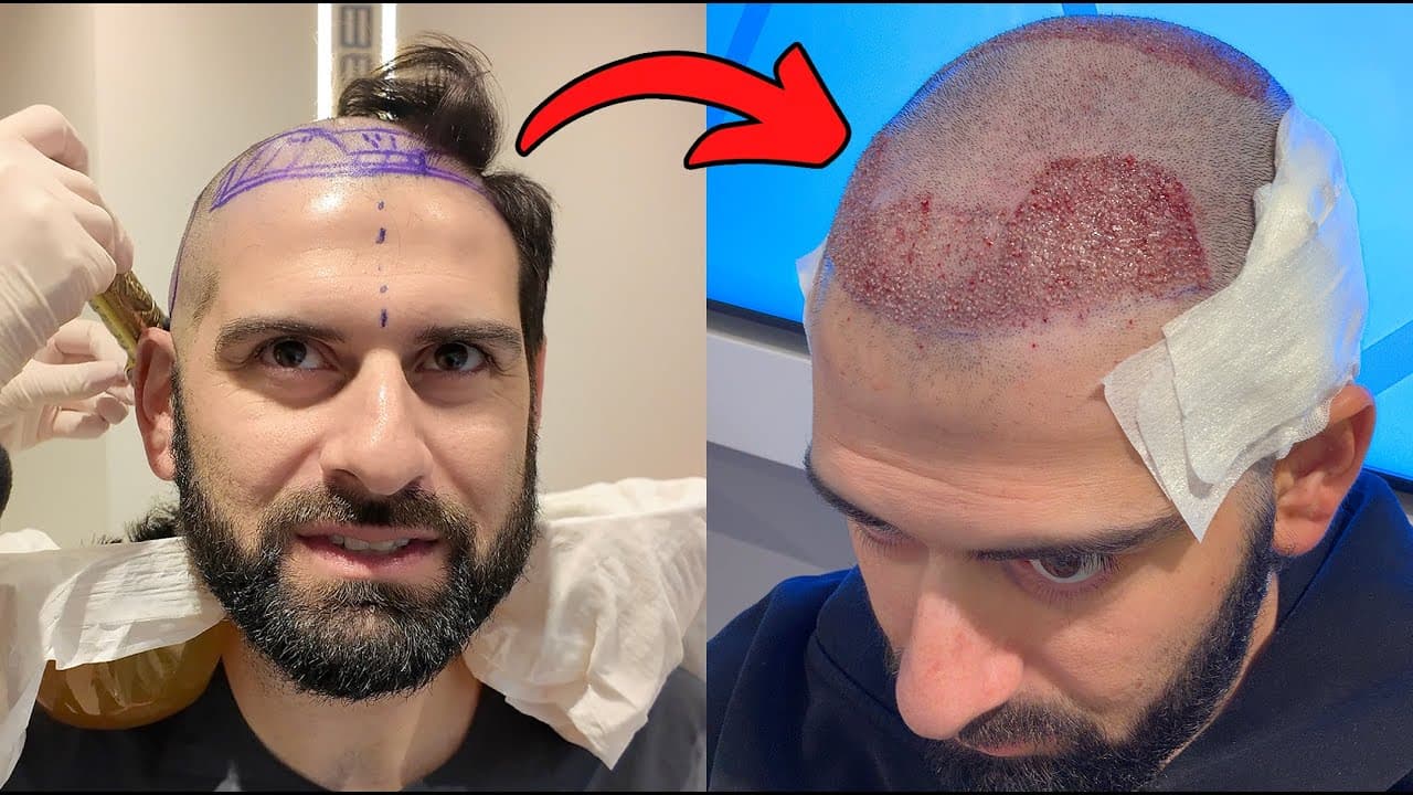 New York Hair Replacement for Everyday Confidence